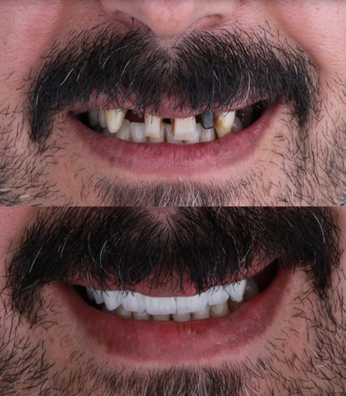 ایمپلنت دیجیتال قبل و بعد