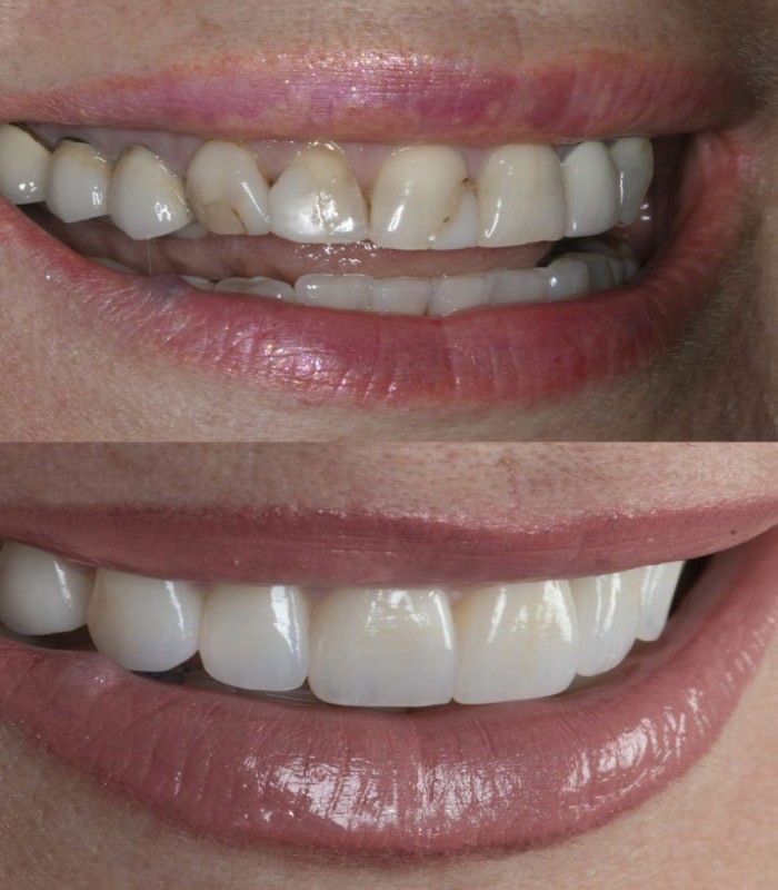 روکش زیرکونیا