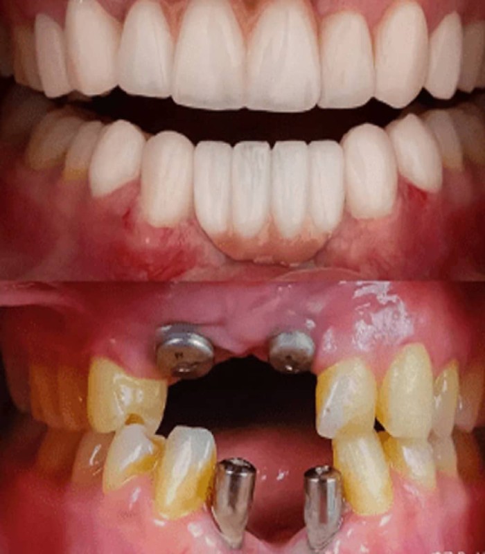 قبل و بعد ایمپلنت دیجیتال