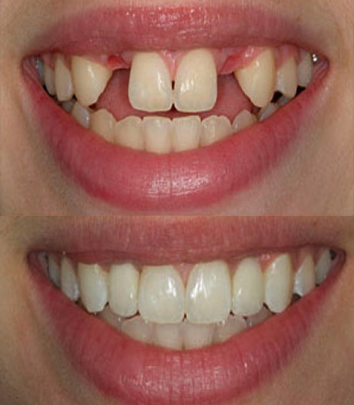 ایمپلنت تمام دیجیتال