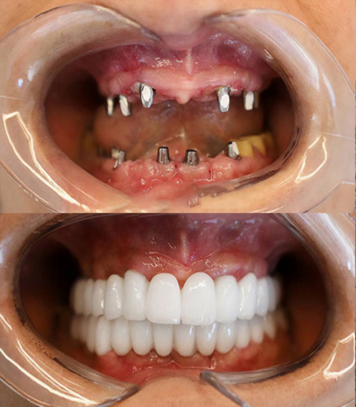 ایمپلنت یک روزه