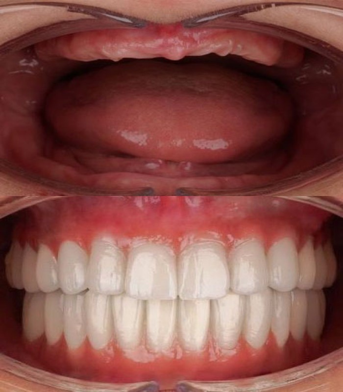 ایمپلنت فول فک