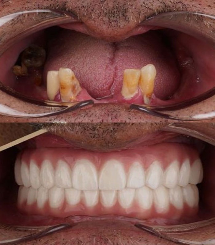 ایمپلنت فول فک