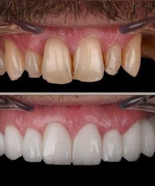 روکش زیرکونیا