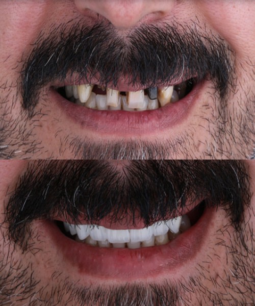 ایمپلنت یک روزه