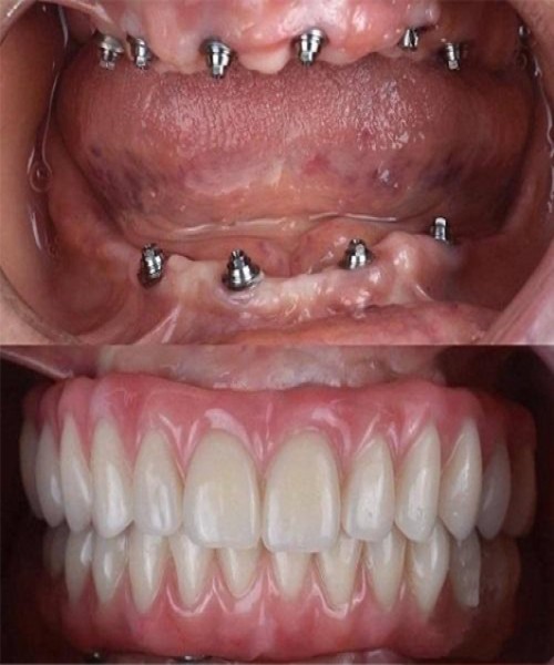 قبل و بعد ایمپلنت دیجیتال