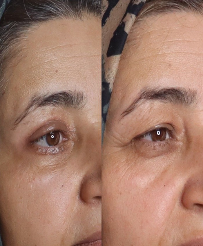 بلفاروپلاستی پلک بالا و پایین