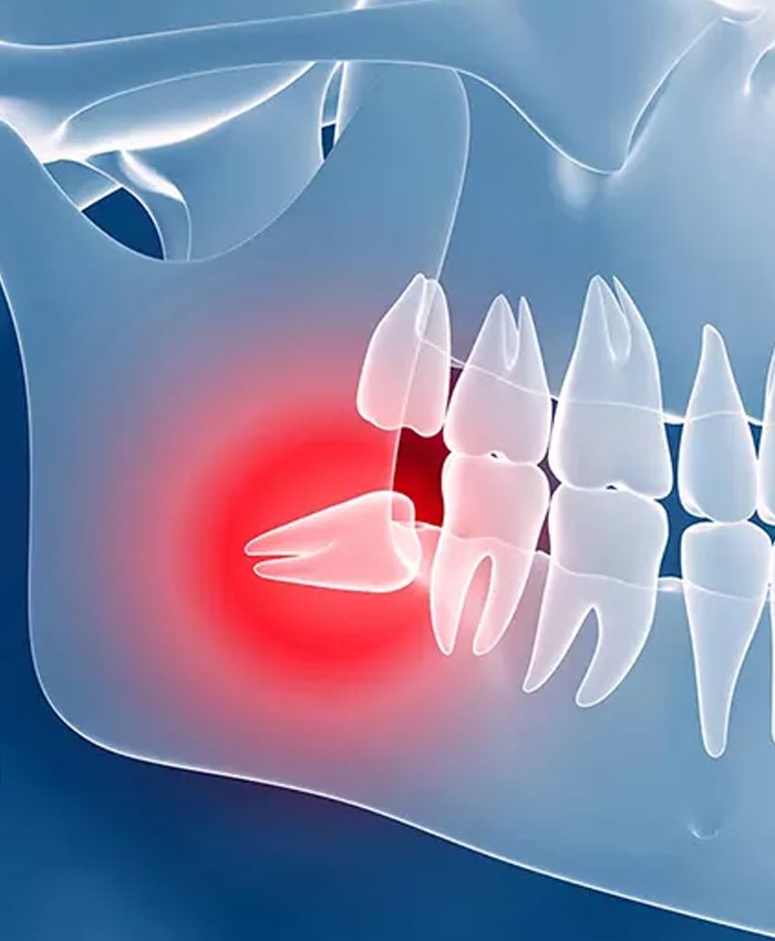 جراحی دندان نهفته